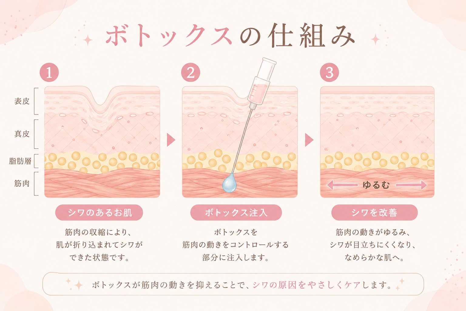 ボトックス注入の説明画像