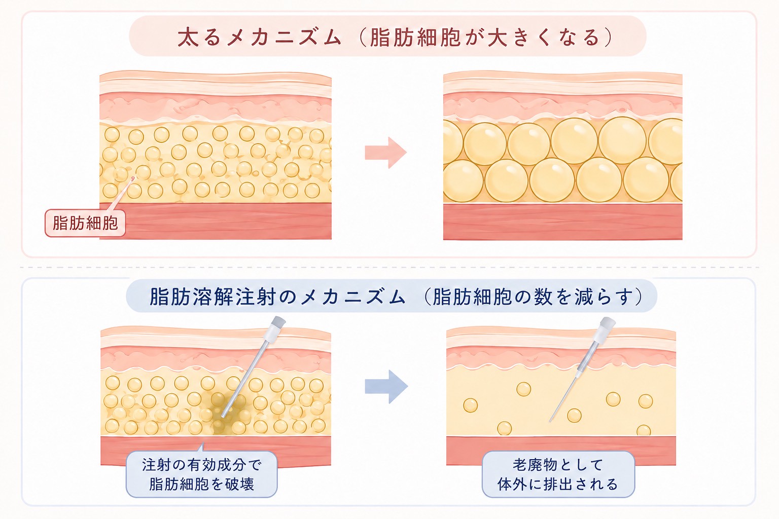 痩身治療の説明画像