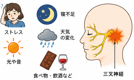 片頭痛の原因と増悪因子